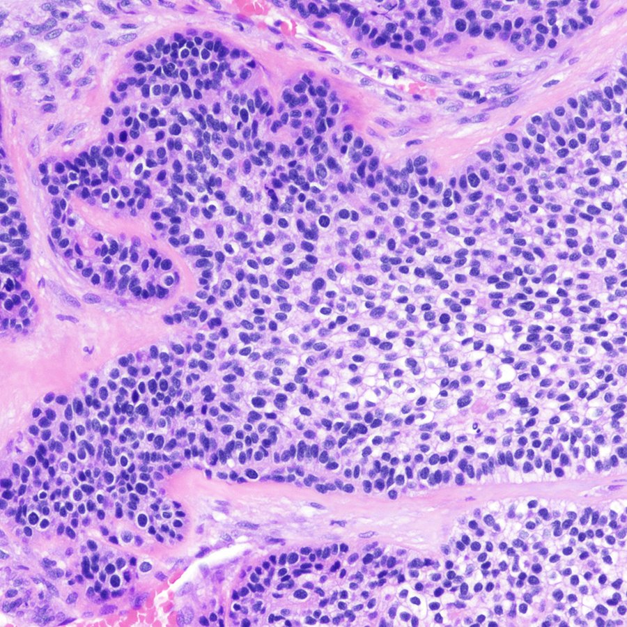 CraigHorbinski's tweet photo. Extremely rare case of a hyalinizing clear cell carcinoma of the salivary gland metastasizing to the spine. Striking pattern at low power. #pathology #neuropath #PathTwitter https://t.co/i2inrLvhne