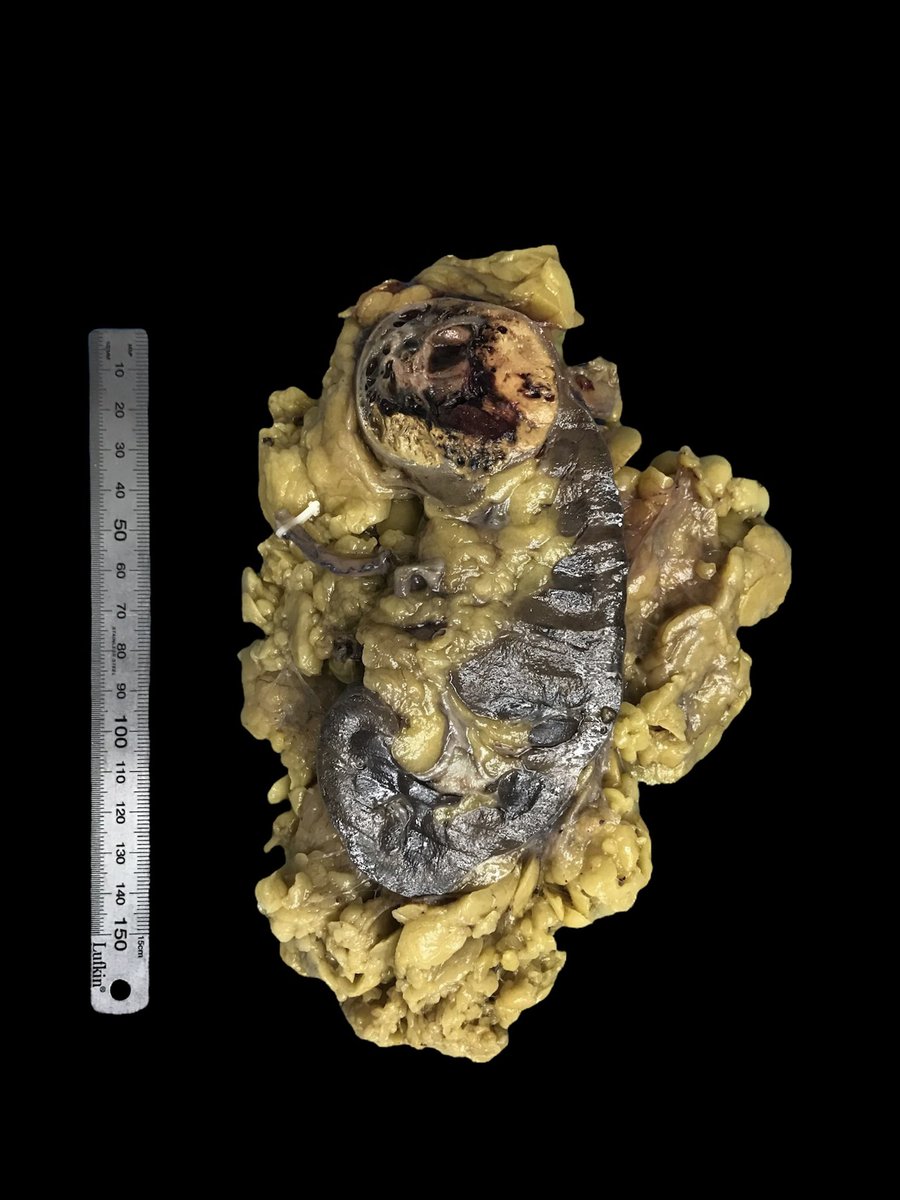 drshanebattye's tweet photo. You can automatically remove messy gross specimen backgrounds with the PhotoRoom app by @photoroom_app 

Black works well but you can choose any colour/shadow/outline 

Can you identify the organ and tumour? 😀

#pathology #pathart https://t.co/2q9oeDJEN3