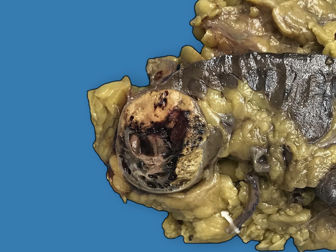 You can automatically remove messy gross specimen backgrounds with the PhotoRoom app by @photoroom_app 

Black works well but you can choose any colour/shadow/outline 

Can you identify the organ and tumour? 😀

#pathology #pathart