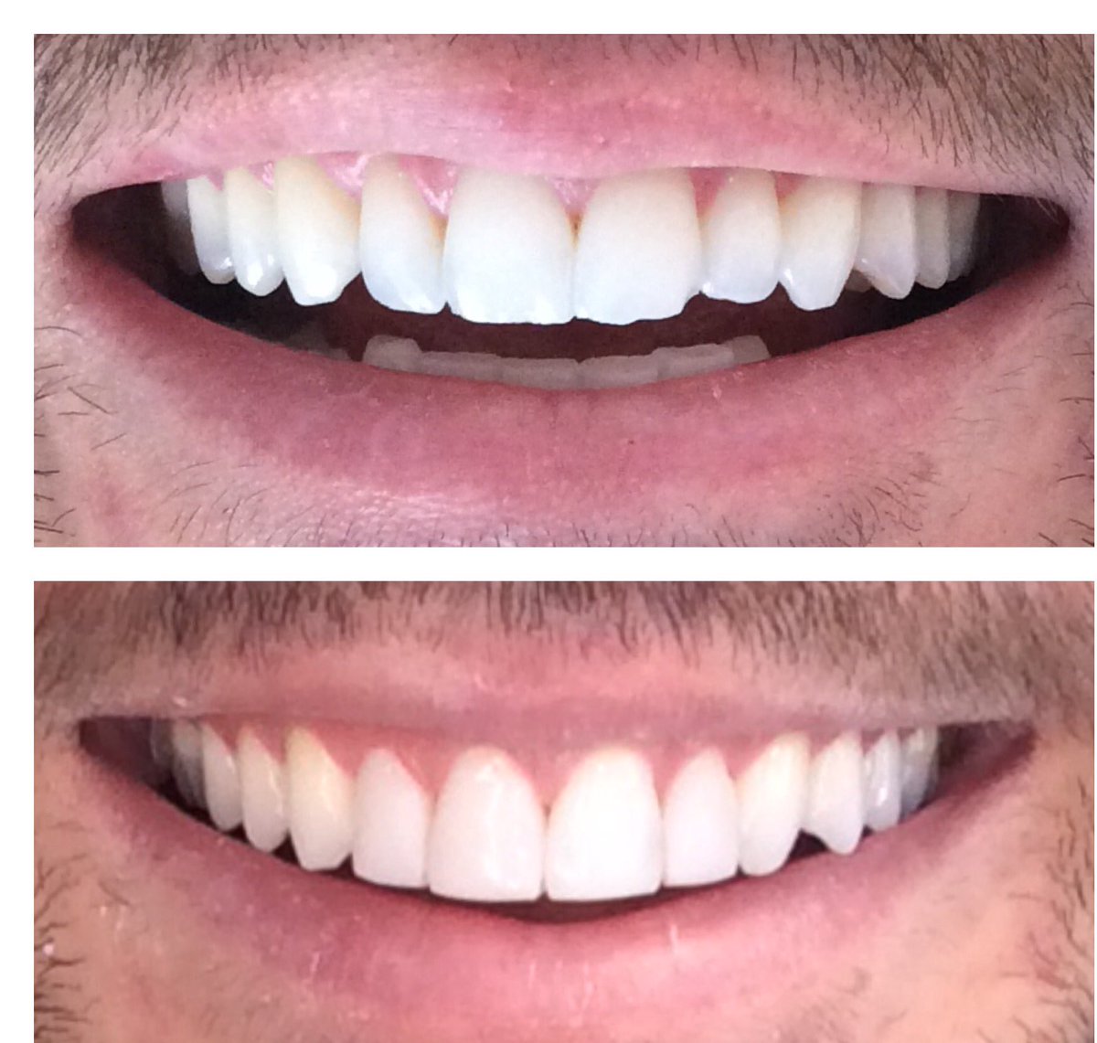 What a beautiful transformation🙌🏻✨ Composite bondings giving that summer smile ready vibes. 

#compositebonding #compositeveneers #dentistd4