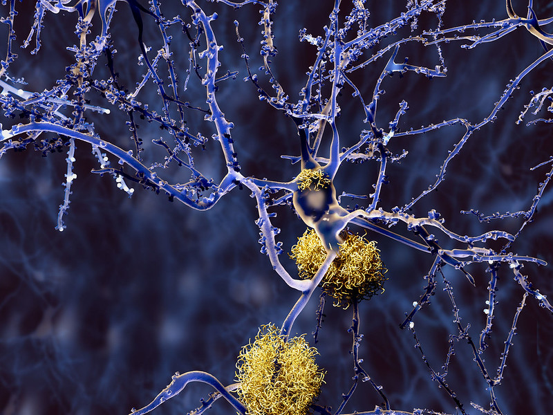 MGHNeuroSci's tweet photo. Clara Vila-Castelar, PhD, and Yakeel T. Quiroz, PhD of @MGHmapp, and colleagues have been investigating sex differences in Alzheimer's disease in a large Colombian kindred that has the E280A mutation in Presenilin-1 (PSEN1). Read their findings @ytquiroz https://t.co/dLc6yrMgE3 https://t.co/W77JawJcsQ