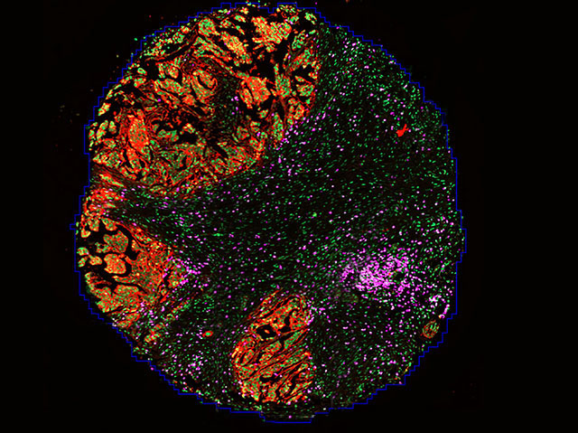 Biomedical Picture of the Day BPoD (@bpod_s) on Twitter photo Blocking tumour protein FAK releases checkpoint brake making #ovariancancer susceptible to #immunotherapy. Image and research by <a href="/DOzmadenci/">Duygu Ozmadenci</a> et al <a href="/UCSDCancer/">UC San Diego Health Moores Cancer Center</a> <a href="/UCSD_ObGyn/">UC San Diego OBGYN</a> <a href="/UCSDCRCERA/">UCSD Health Moores Cancer Center CRCERA</a> in <a href="/PNASNews/">PNASNews</a>. Read more on bpod.mrc.ac.uk/archive/2022/7… with <a href="/MRC_LMS/">MRC Laboratory of Medical Sciences (LMS)</a> and <a href="/AntDLewis/">Ant Lewis</a> Blocking tumour protein FAK releases checkpoint brake making #ovariancancer susceptible to #immunotherapy. Image and research by <a href="/DOzmadenci/">Duygu Ozmadenci</a> et al <a href="/UCSDCancer/">UC San Diego Health Moores Cancer Center</a> <a href="/UCSD_ObGyn/">UC San Diego OBGYN</a> <a href="/UCSDCRCERA/">UCSD Health Moores Cancer Center CRCERA</a> in <a href="/PNASNews/">PNASNews</a>. Read more on bpod.mrc.ac.uk/archive/2022/7… with <a href="/MRC_LMS/">MRC Laboratory of Medical Sciences (LMS)</a> and <a href="/AntDLewis/">Ant Lewis</a>