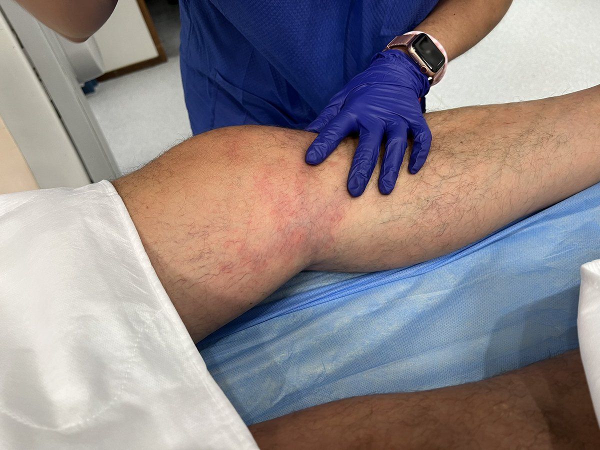 Eduardo Crespo (@dreduardocrespo) on Twitter photo Hoy ha venido <a href="/AnaFM_IR/">Ana Fernández Martínez</a> al <a href="/Hospital_FJD/">Fundación Jiménez Díaz</a> a ayudarnos con nuestra primera embolizacion articular en una osteoartritis de rodilla . El paciente ha pasado de dolor 8 a 3 (escala VAS) en menos de 4 horas . Antes sesión conjunta con <a href="/rehabilitacion/">Leonor H</a>. Que bien lo pasamos 🎉🦵🏻<a href="/SERVEISoc/">SERVEI - Radiología Vascular Intervencionista</a> Hoy ha venido <a href="/AnaFM_IR/">Ana Fernández Martínez</a> al <a href="/Hospital_FJD/">Fundación Jiménez Díaz</a> a ayudarnos con nuestra primera embolizacion articular en una osteoartritis de rodilla . El paciente ha pasado de dolor 8 a 3 (escala VAS) en menos de 4 horas . Antes sesión conjunta con <a href="/rehabilitacion/">Leonor H</a>. Que bien lo pasamos 🎉🦵🏻<a href="/SERVEISoc/">SERVEI - Radiología Vascular Intervencionista</a>