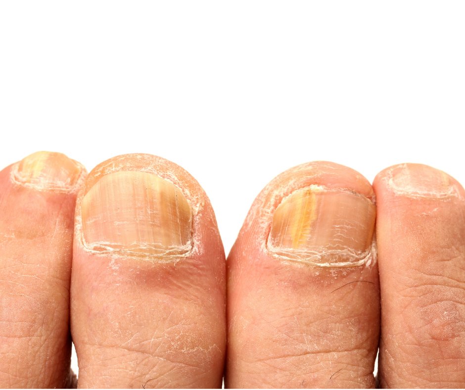 During the #summer months, #DrAnthonyWeinert sees a rise in cases of #toenailfungus. Some people who have never before had success with other #fungal therapies are finally seeing improvement in the appearance of their nails with #lasertherapy. Learn more: bit.ly/3r93fsr