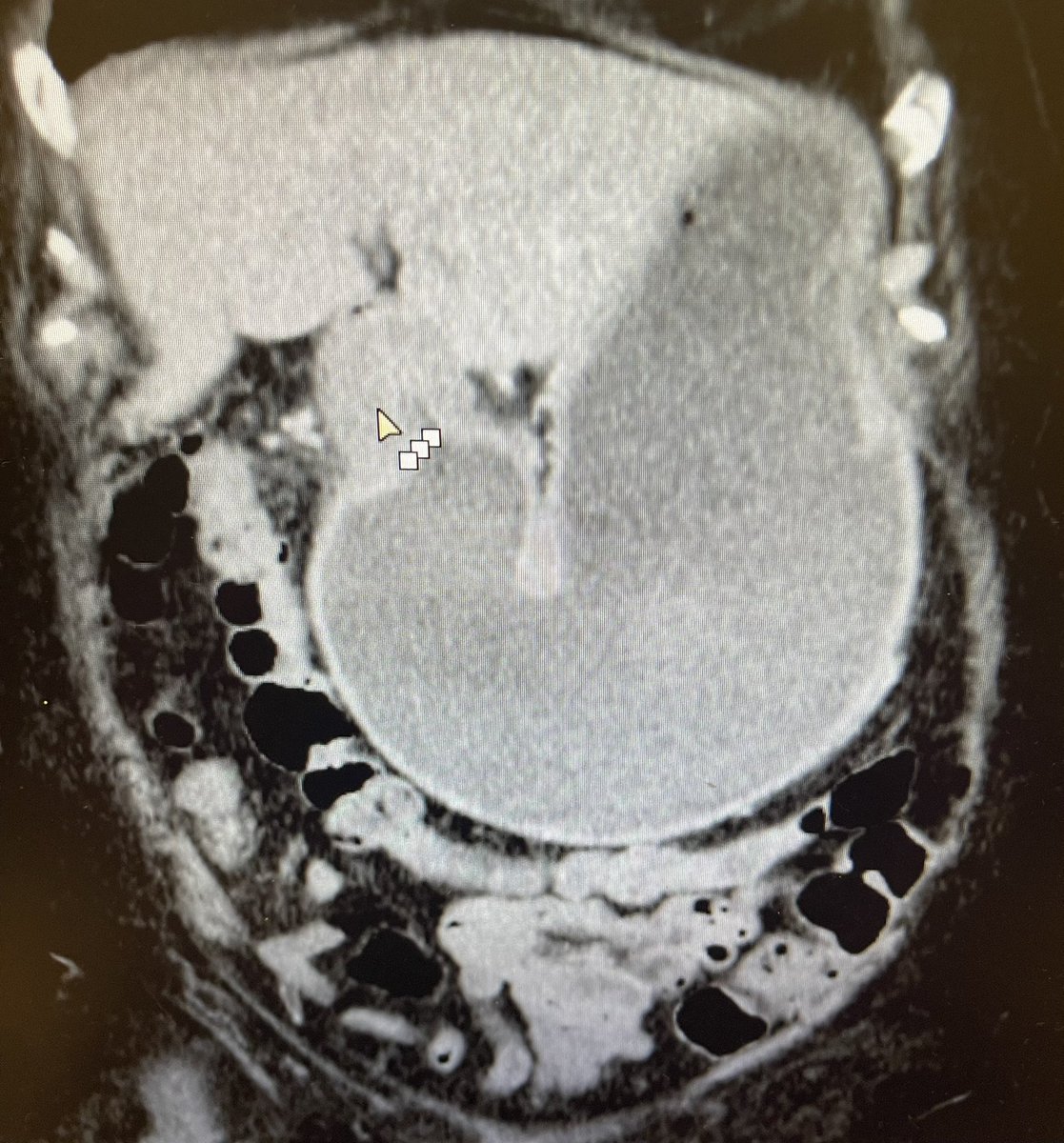 MarijoRojasMD's tweet photo. EUS FNB to the diagnosis rescue - 92 yo female presenting with GOO. CT ➡️ antral thinking.  EGD➡️ normal antrum normal biopsies. EUS w/FNB of wall - invasive poorly cohesive gastric carcinoma. Yes we biopsy everything 😊            Utilidad diagnóstica del UE/bx aguja fina 👇🏻hilo https://t.co/et9n7ZccMD