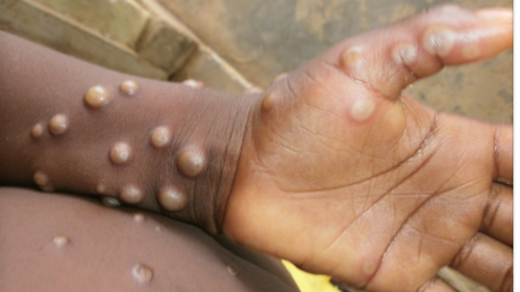 IDRC_CRDI's tweet photo. Want to find out about an upcoming #Funding Opportunity, supporting a rapid #research response to outbreaks of #Monkeypox in Canada and Africa, with our partner @CIHR_IRSC? Details: https://t.co/8lzwzAJ7be https://t.co/rgWJhP3zJm