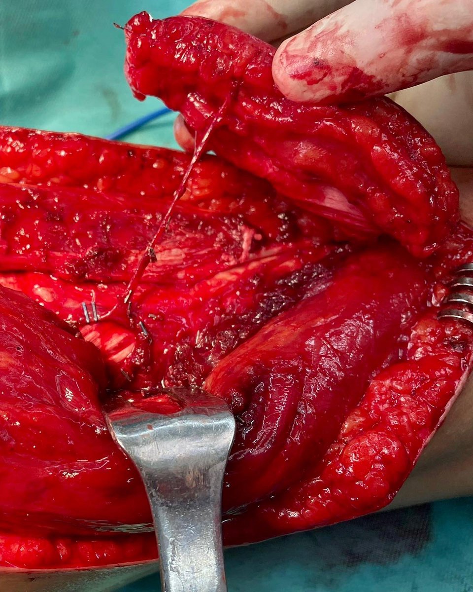 DrBarreraochoa's tweet photo. Colgajo ALT (Anterolateral Thigh Flap)
▪️Secuelas de reconstrucción de LCL de rodilla, con zona de mala calidad cutánea, muy friable y heridas de repetición durante la práctica deportiva 
▪️Colgajo Vascularizado por la rama descendente de la arteria femoral circunfleja lateral https://t.co/ErWyK8kPIE