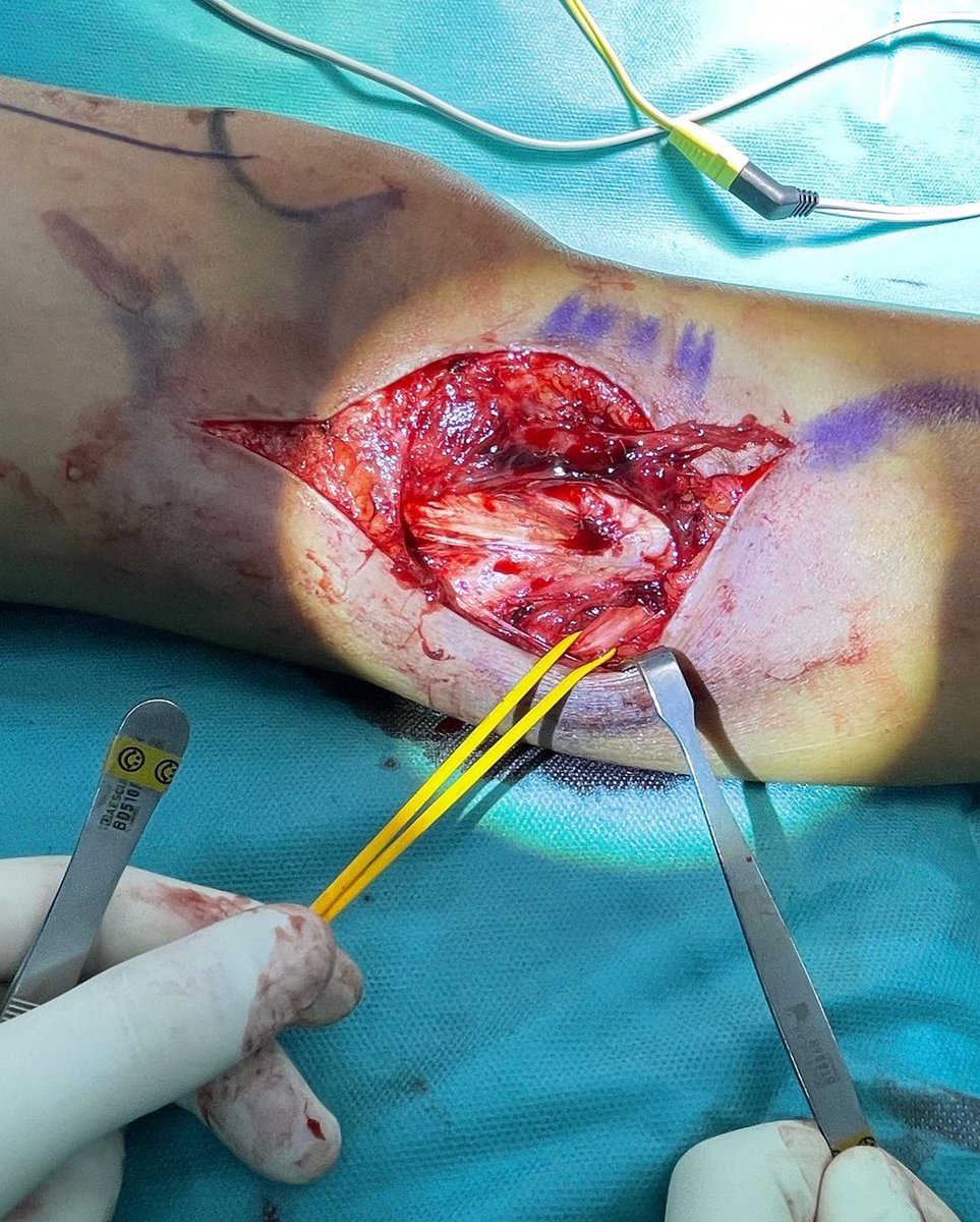 Colgajo ALT (Anterolateral Thigh Flap)
▪️Secuelas de reconstrucción de LCL de rodilla, con zona de mala calidad cutánea, muy friable y heridas de repetición durante la práctica deportiva 
▪️Colgajo Vascularizado por la rama descendente de la arteria femoral circunfleja lateral