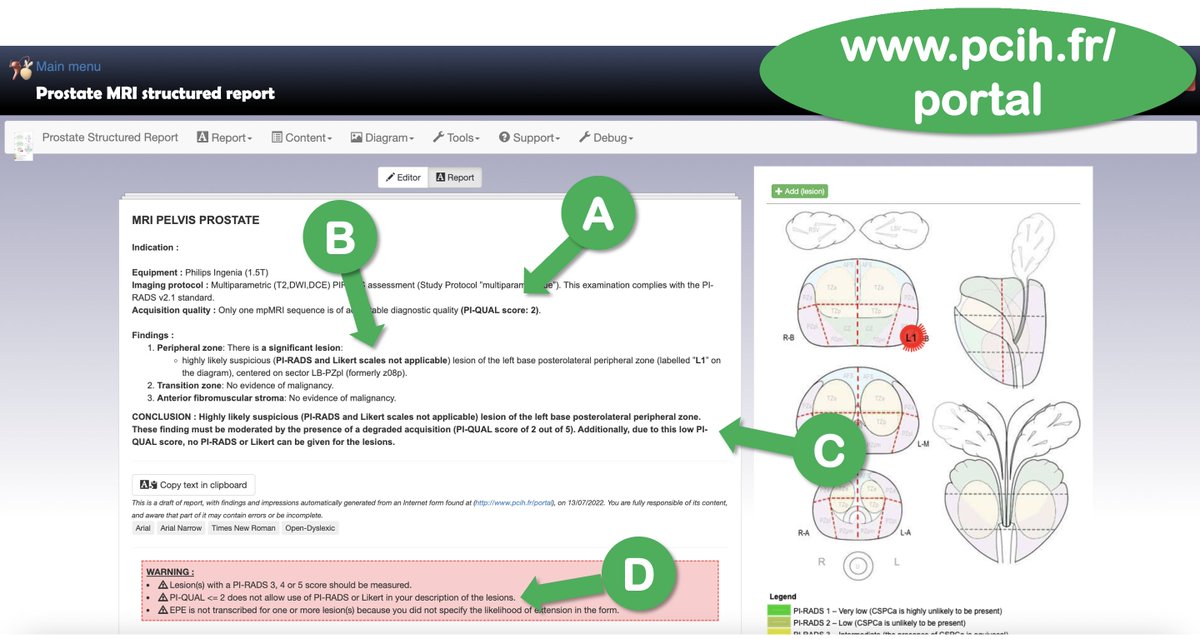 Following recent <a href="/PascalBaltzer/">Pascal Baltzer</a> and <a href="/giga_fra/">Francesco Giganti</a> tweets, I updated the online #prostate #MRI #SR software.
A : #PIQUAL in all reports++
B : No #PIRADS or Likert if PI-QUAL&lt;3
C : This has to be explained in the report conclusion/impressions
D : The software warns the user about it