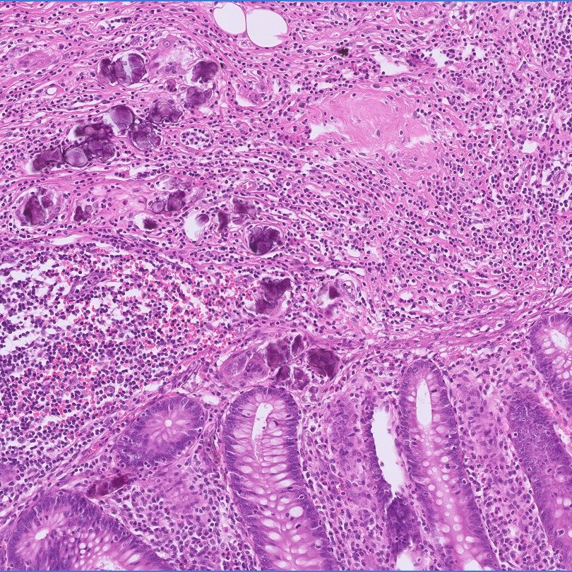 D4L14H's tweet photo. Clinically diagnosed as "Obstructive appendicitis"
πβπ¨ #PathBoard cases for junior residents.
#Pathology #GIpath
@muradi1993 @Rawan_Hudairy - Tag your junior friends!π https://t.co/lvTgNVe0YW