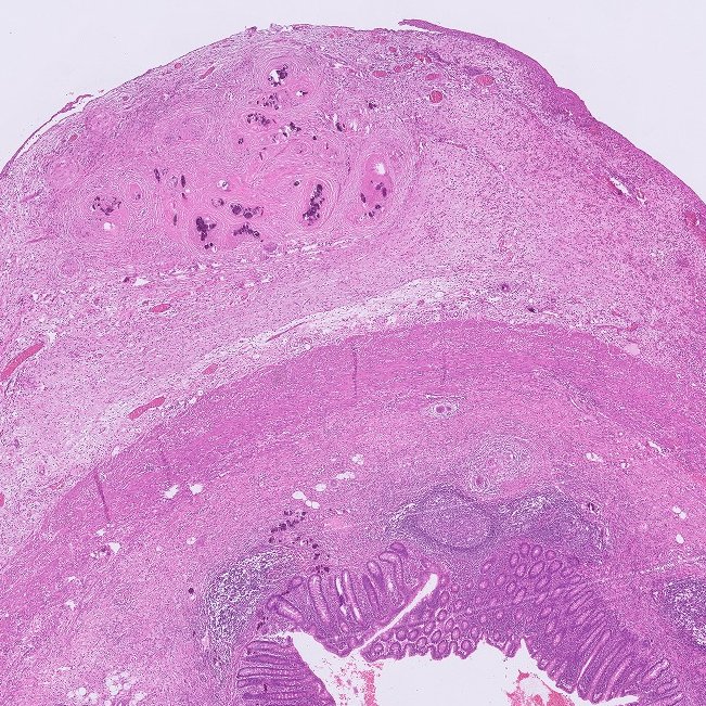 D4L14H's tweet photo. Clinically diagnosed as "Obstructive appendicitis"
πβπ¨ #PathBoard cases for junior residents.
#Pathology #GIpath
@muradi1993 @Rawan_Hudairy - Tag your junior friends!π https://t.co/lvTgNVe0YW
