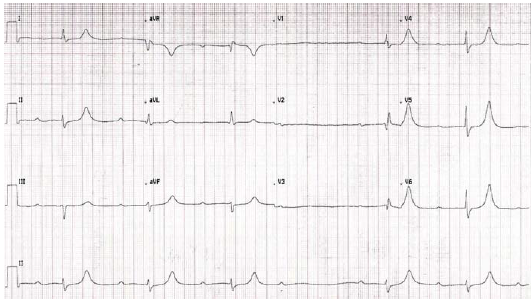 Is #BRASHsyndrome, #hyperkalemia, #ACS, or #hypocalcemia causing the #ECG findings in this patient? @EM1MinuteGuru has the answer. #Whatsthediagnosis #FOAMed @smithECGBlog bit.ly/3nN5b7Q