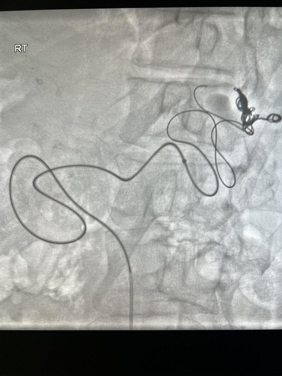 IndyIRmd's tweet photo. New #Embold detachable coils get there despite extreme tortuosity! Not easy, but made it all the way. #twittIR #IRad #Indy https://t.co/GqRihWq3ke