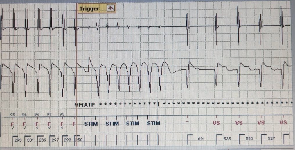What’s the rhythm ? #eppeeps #cardiotwitter