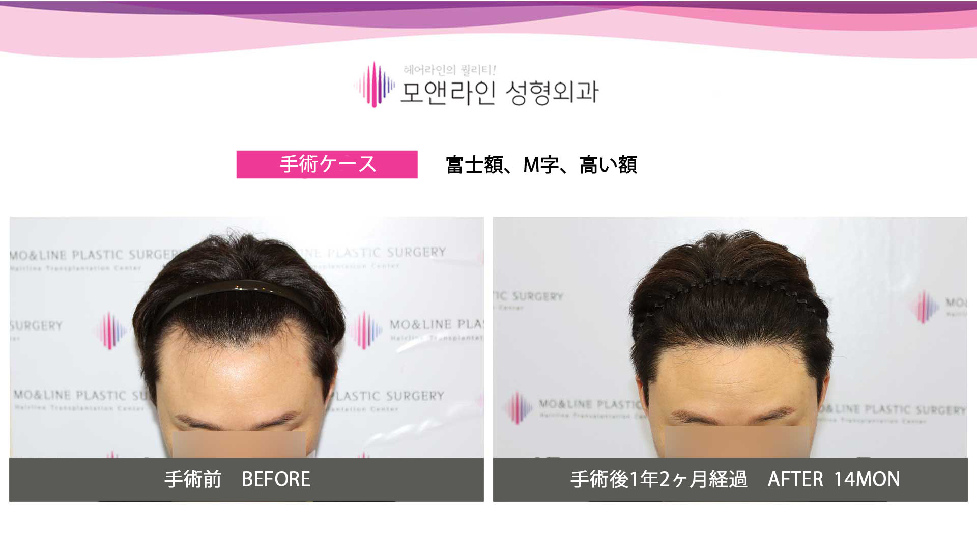 헤어라인 Twitter Search Twitter