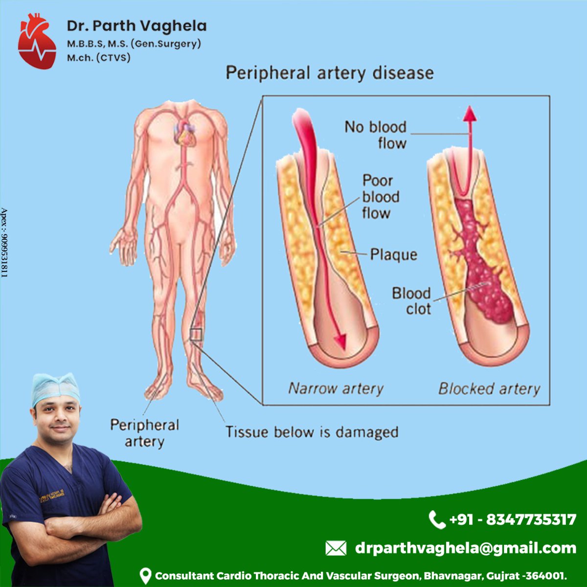 PERIPHERAL ARTERY DISEASE

#peripheralarterydisease #nobloodflow #poorbloodflow #plaque #bloodclot #narrowartery #blockedartery #peripheralartery #drparthvaghela #doctor #hospital #endovenouslasertreatment #CTVS #cardiothoracicsurgery #vascularsurgery #bhavnagar #Gujarat
