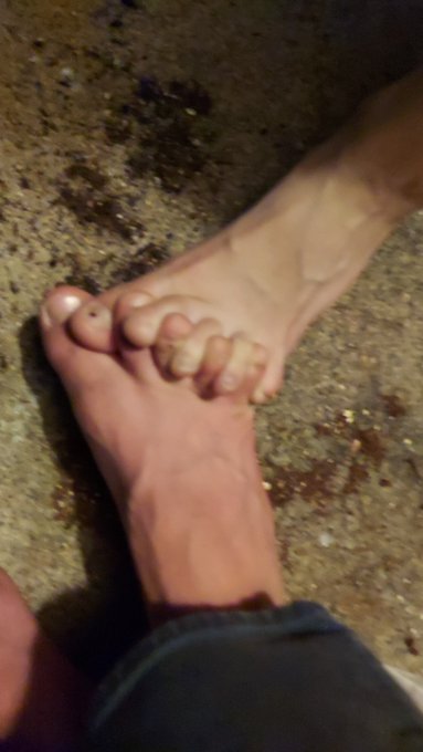 #feet #feetworship #feetfinder #feetpicsforsales #feetfethish #amputeesofinstagram #amputeepics https://t