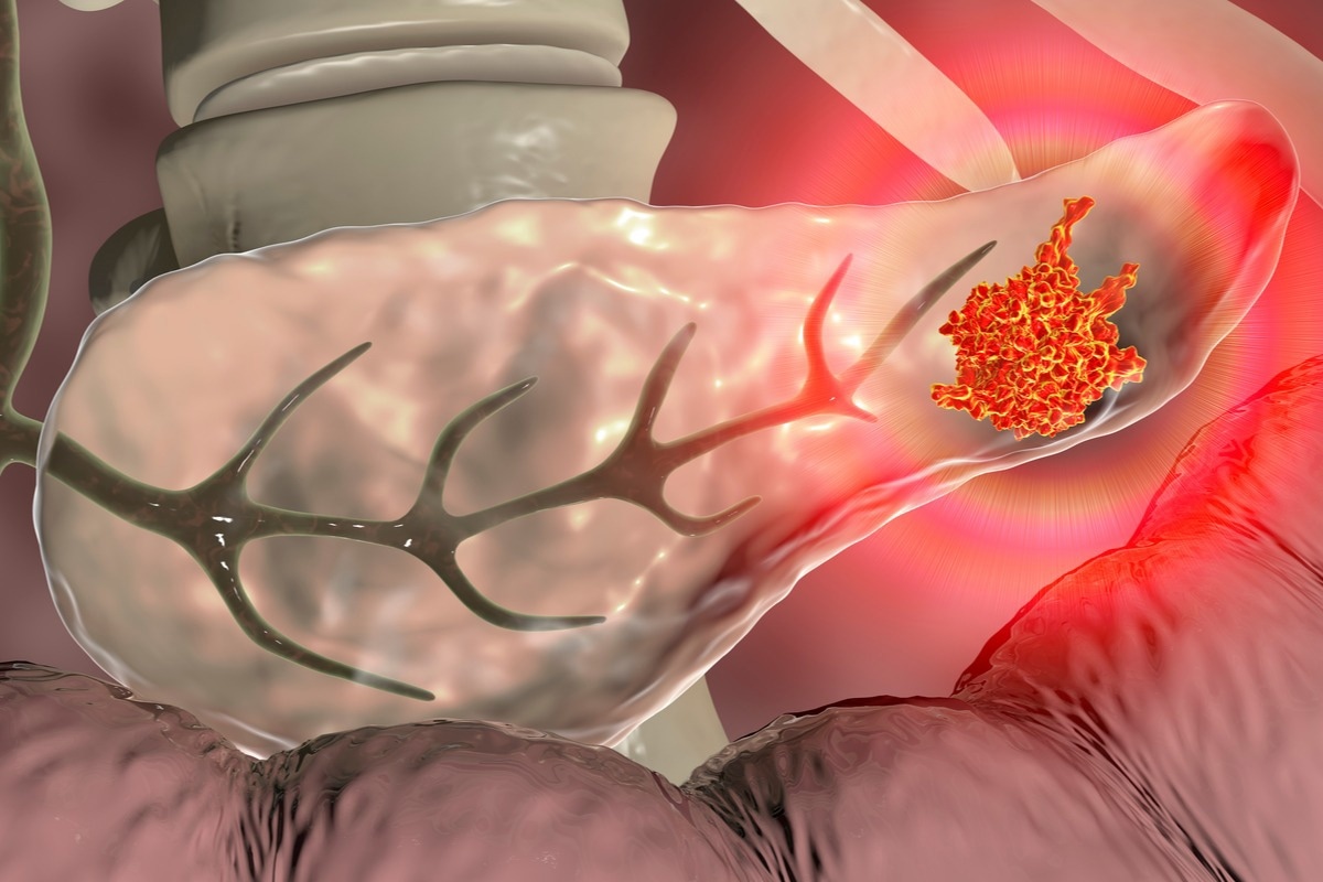 We speak to <a href="/linxiang_lan/">Linxiang Lan</a> a staff scientist at <a href="/ICR_London/">The ICR</a> and the lead author of a paper that presents a fundamental discovery that could pave way for new pancreatic cancer treatments news-medical.net/news/20220714/… #cancer #cancerresearch #pancreaticcancer #disease #research