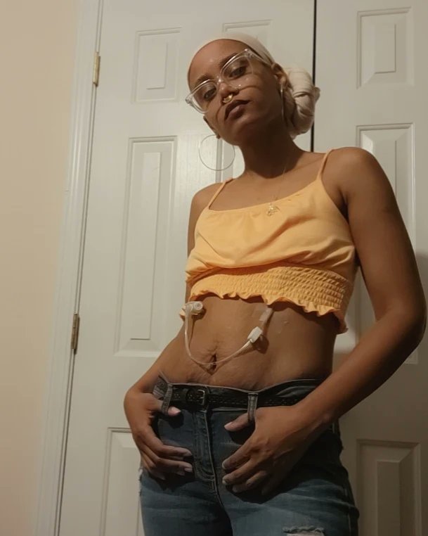 genesiz613's tweet photo. Late post:[7/13] its my #Tubieversary 2 yrs in da game! Im #Grateful to have this tool to help me be here w/all of u! New (scary) health tings r happening bt u kno ill keep u updated!
#Tubie
#HawtDisabledBodies 
#Gastroparesis 
#ChronicallyIllAf 
#MyTummyDoesntWork
#DisabledModel https://t.co/ghRI7XGUs1