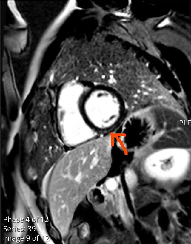 My friends cardiac MRI. The scar being pointed to is #Myocarditis (only visible with dye). My friend, said; "there's nothing I can do about it, the scar...this is it". He's a 30 year old man, with a one year old son, and a wife. A #jected contributed to this result. #StoptheShots