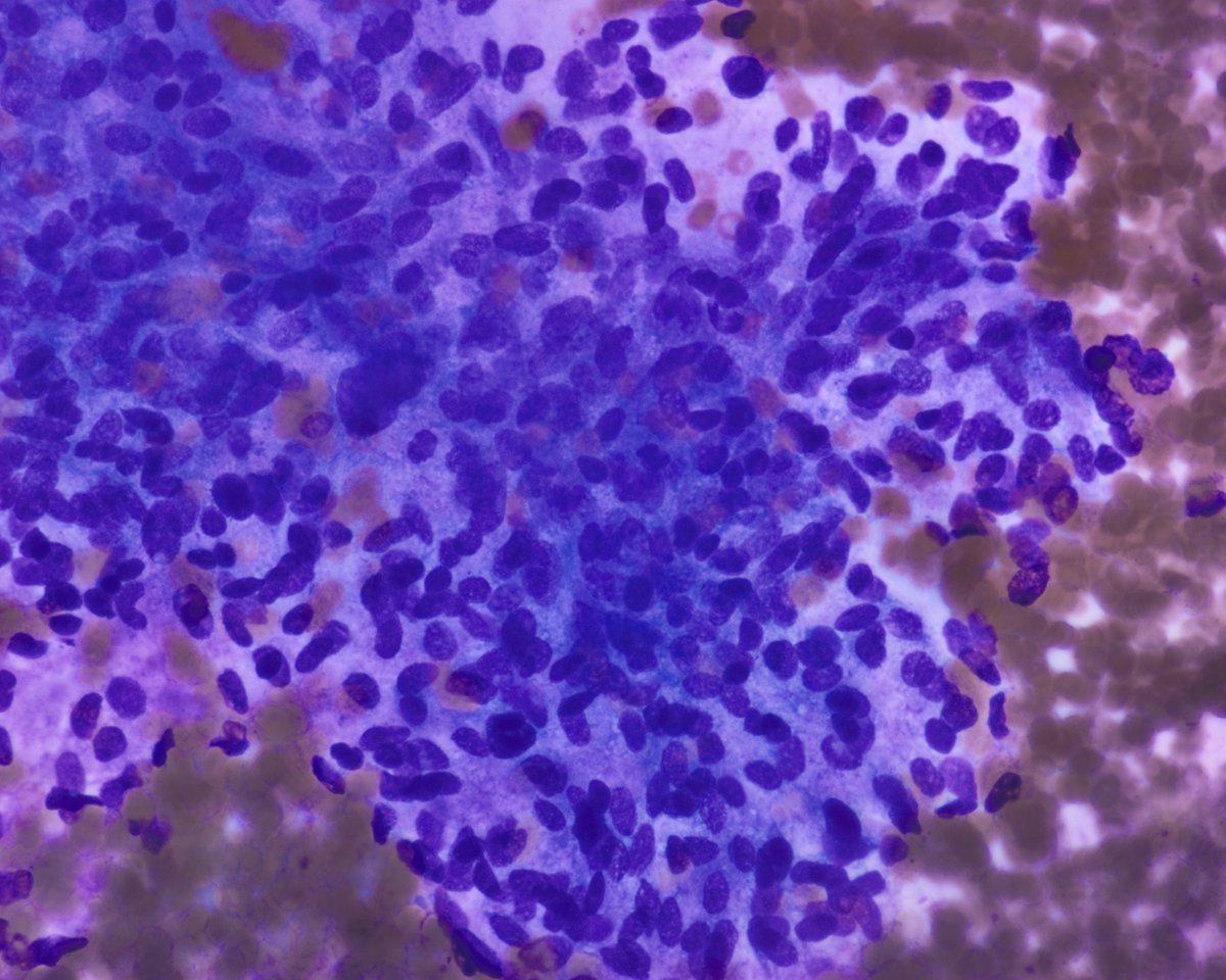 pepeheffernan's tweet photo. The clinical info: "suspicious thyroid nodule, increased CEA". The antibodies are calcitonin and INSM1. The diagnosis, medullary TC. Here you have some DQ images (oval to spindle) and synaptophysin. You were not expecting INSM1. Merit of the requesting 🩺: CEA⬆️, it made us move https://t.co/3m4Q87DVYE
