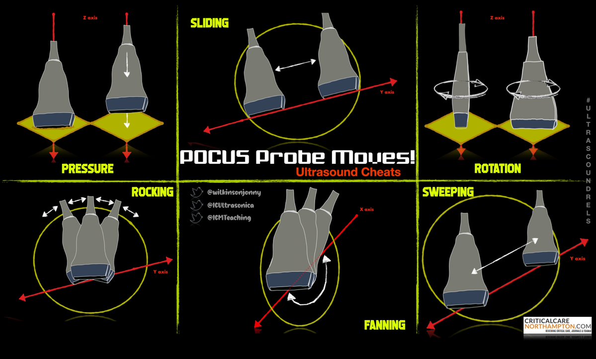NephroPOCUS (@nephrop) on Twitter photo Basic transducer movements.
#POCUS #IMPOCUS #MedEd #Nephrology
Courtesy: <a href="/Wilkinsonjonny/">Jonny Wilkinson</a> criticalcarenorthampton.com/pocusgrams/ Basic transducer movements.
#POCUS #IMPOCUS #MedEd #Nephrology
Courtesy: <a href="/Wilkinsonjonny/">Jonny Wilkinson</a> criticalcarenorthampton.com/pocusgrams/
