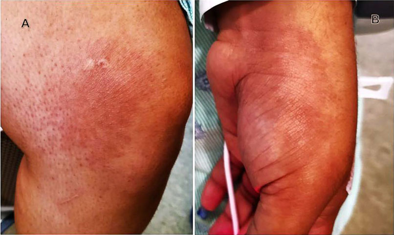 AnnalsofIMCC's tweet image. New: #Ileitis in Adult Multisystem Inflammatory Syndrome. Read the full #casereport from @MedicalCollege at ow.ly/mSxt50JW4zK. Published by @ACPinternists and @American_Heart