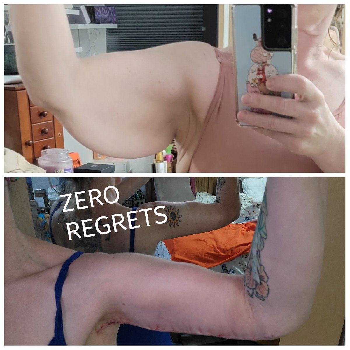 gldngrrl's tweet photo. Ok time for progress pictures. Still swollen, but the difference is clear. 
#lowerbodylift #plasticsurgery #armlift #brachioplasty #medialthighlift @NewvueSurgery https://t.co/mWJpyZVXWp