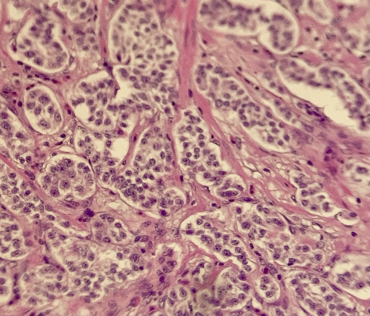 AlxFtn's tweet photo. NET, stomach grade 2, NOS (type? π€·πΌββοΈ) HE stain
#tenpath #netpath #GIpath https://t.co/L8XlScAqqI