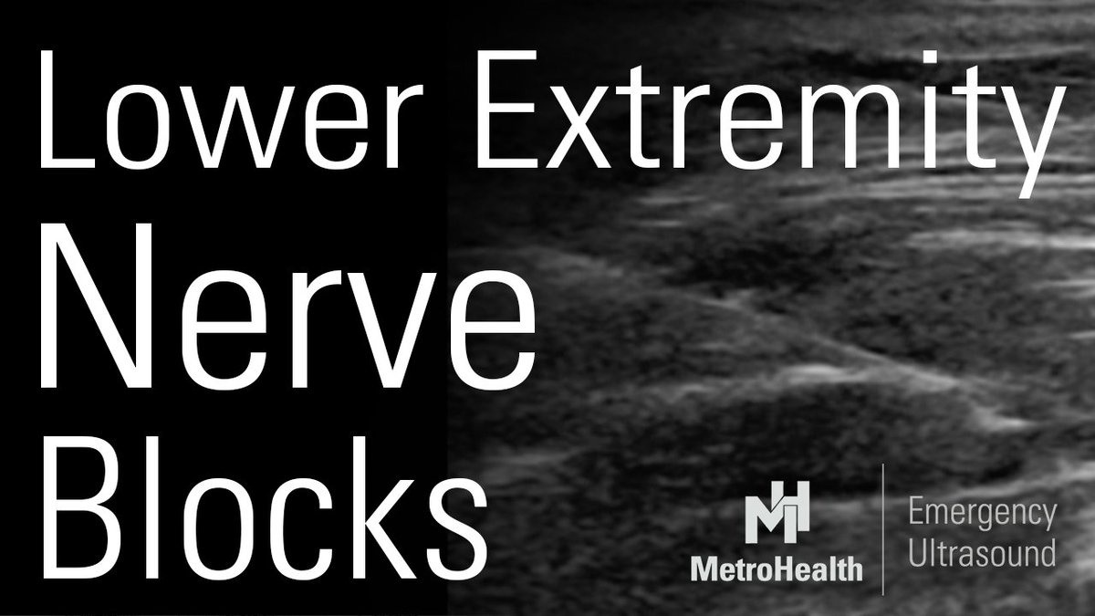 Check out the latest video from our Ultrasound Grand Rounds about Ultrasound Guided Lower Extremity Nerve Blocks.
youtu.be/466cDoLdVZQ
#MetroEUS #POCUS #Ultrasound #FOAMed #FOAMus #EmergencyMedicine #Anesthesiology #NerveBlocks