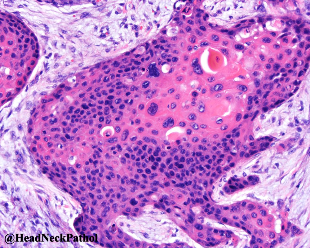 Human Papillomavirus-Associated Oral Cavity Squamous Cell Carcinoma: An Entity with Distinct Morphologic and Clinical Features
By Lewis Jr., Smith, Wang, Tong, Mehrad &amp; Lang-Kuhs
rdcu.be/cRDzO
#HeadNeckPathol #HNPJ #HeadandNeckPath #Pathology #ENTPath #PathologyTweet