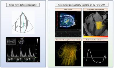 EuropHospital's tweet photo. Cutting-edge #4Dimaging technology to help doctors better diagnose and monitor patients with heart failure. The state-of-the-art technology uses #MRI to create detailed 4D flow images of the heart. @uniofeastanglia @HEARTinMagnet #cardiacimaging https://t.co/EBdrh99CeK https://t.co/OcCxIFuDVc