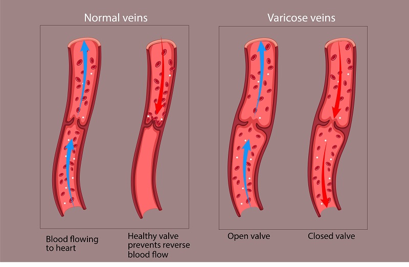 awkashi's tweet photo. #VaricoseVeinSurgery Basically, the valves in the veins in legs, the blood flow one way (i.e. towards the heart). However, with #VaricoseVein, the valves start to leak and the blood can flow downward (towards the feet) and result in VV.
#illustration
#surgery #medicalillustration https://t.co/HPdKyQrNa8