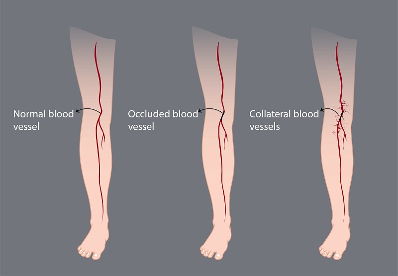 awkashi's tweet photo. #VaricoseVeinSurgery Basically, the valves in the veins in legs, the blood flow one way (i.e. towards the heart). However, with #VaricoseVein, the valves start to leak and the blood can flow downward (towards the feet) and result in VV.
#illustration
#surgery #medicalillustration https://t.co/HPdKyQrNa8