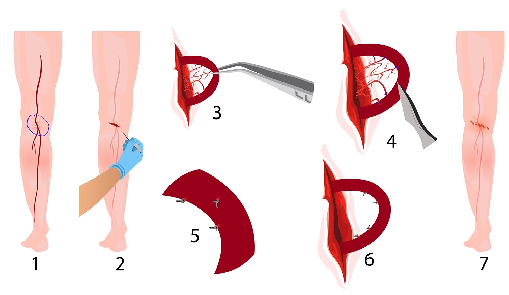 awkashi's tweet photo. #VaricoseVeinSurgery Basically, the valves in the veins in legs, the blood flow one way (i.e. towards the heart). However, with #VaricoseVein, the valves start to leak and the blood can flow downward (towards the feet) and result in VV.
#illustration
#surgery #medicalillustration https://t.co/HPdKyQrNa8