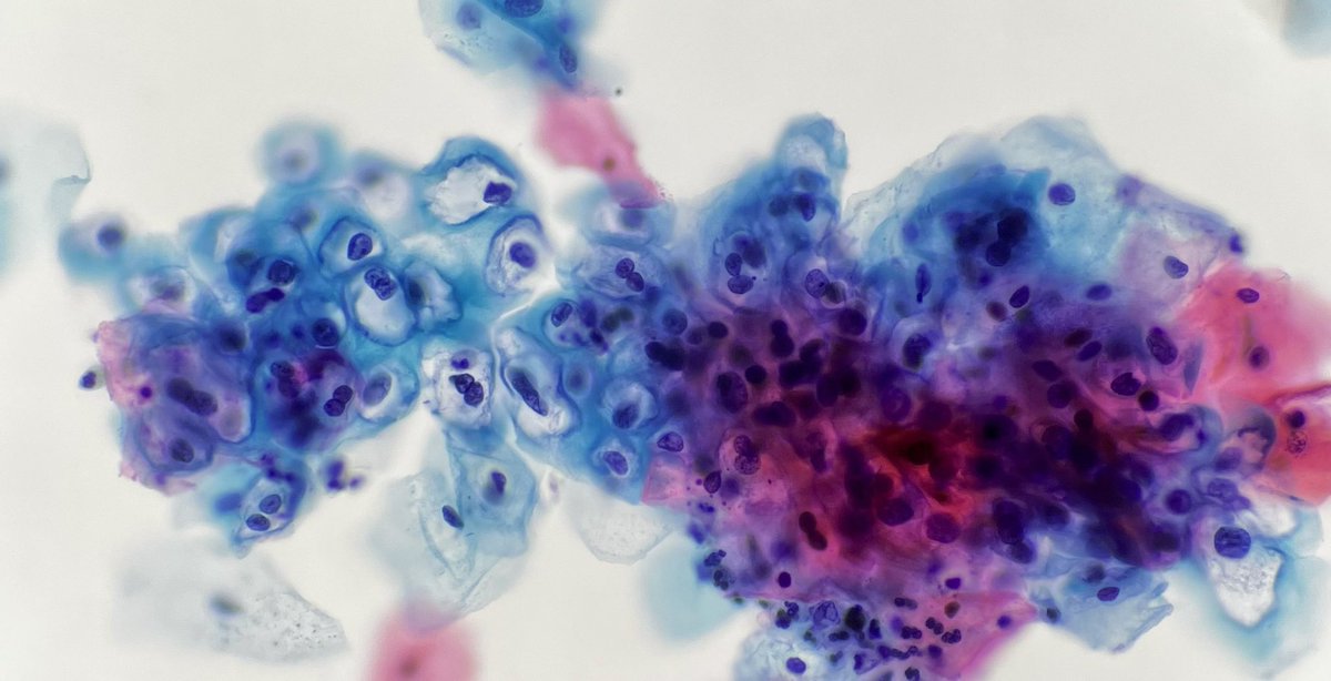The prettiest LSIL … if only they all looked like this. #cytopath