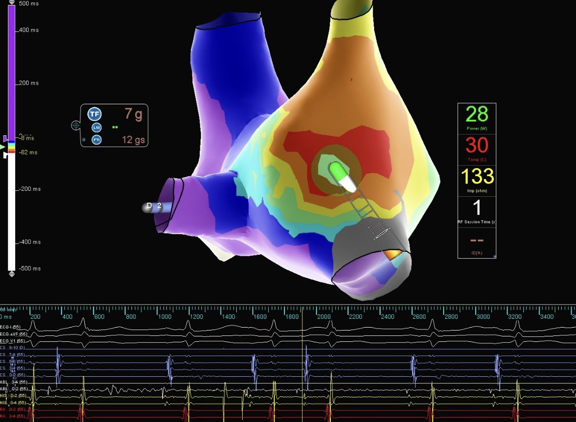 AFPanico (@az_ep_doc) on Twitter photo Nice Right sided AT today…
Pt with frequent episodes of SVT despite medication. Intermediate RP on hospital EKG.
Nothing induced with EPS.
Bi and tri-germinal PACs with short runs on iso… quickly mapped and localized to posterior RA with HD-Grid. Local egm -35 msec. 1 and done! Nice Right sided AT today…
Pt with frequent episodes of SVT despite medication. Intermediate RP on hospital EKG.
Nothing induced with EPS.
Bi and tri-germinal PACs with short runs on iso… quickly mapped and localized to posterior RA with HD-Grid. Local egm -35 msec. 1 and done!