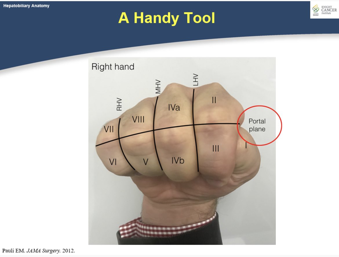 @marklewismd Including the source of this “Handy Tool” and few slides from an HPB Anatomy talk I share with @OHSUsurgery residents and students.