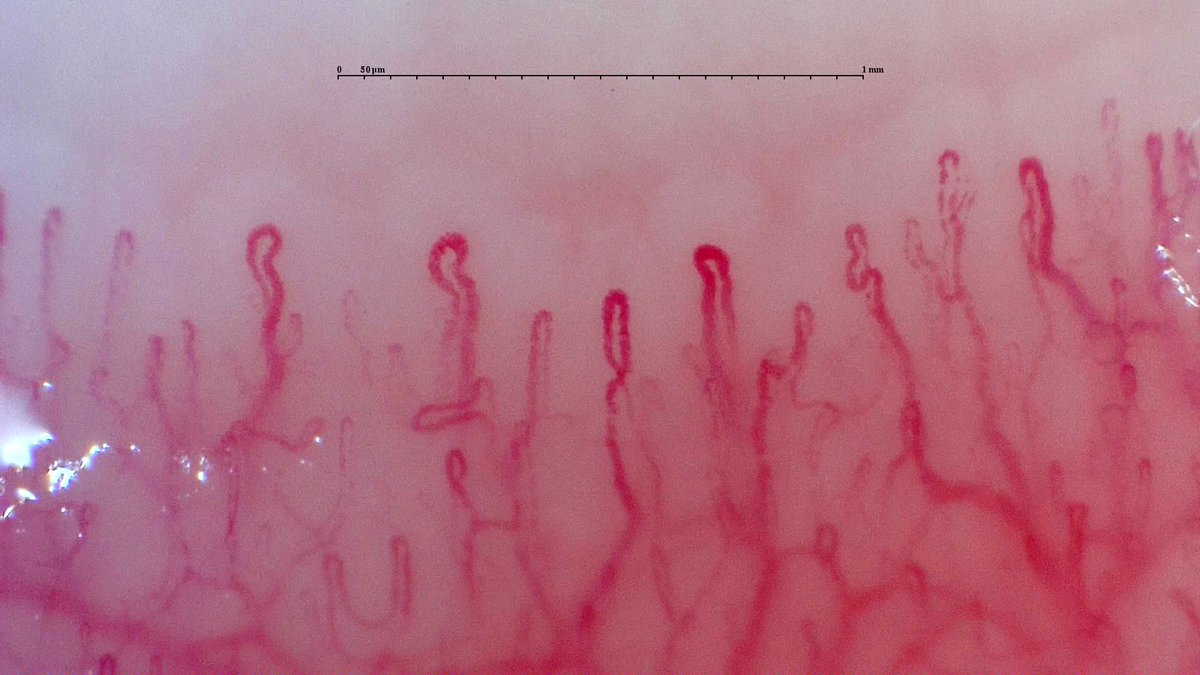 gmaldonadovelez's tweet photo. Initial assessment of Raynaudโs phenomenon ๐ฌ
2nd ๐๐ฝโ๐ฝ
๐ฅ deposit of hemosiderin
๐ฆ enlarged capillaries
3rd ๐๐ฝโ๐ฝ
๐ฆ enlarged capillaries
๐ good density
Conclusion: one hemorrhage is not conclusive for positive study
#MedTwitter #RheumTwitter #CapillaryIo #Raynauds https://t.co/MeqLf81tdp