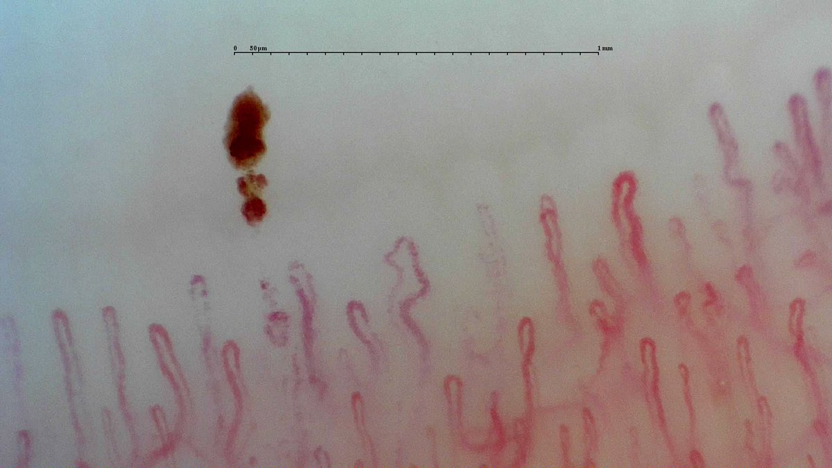 gmaldonadovelez's tweet photo. Initial assessment of Raynaudโs phenomenon ๐ฌ
2nd ๐๐ฝโ๐ฝ
๐ฅ deposit of hemosiderin
๐ฆ enlarged capillaries
3rd ๐๐ฝโ๐ฝ
๐ฆ enlarged capillaries
๐ good density
Conclusion: one hemorrhage is not conclusive for positive study
#MedTwitter #RheumTwitter #CapillaryIo #Raynauds https://t.co/MeqLf81tdp