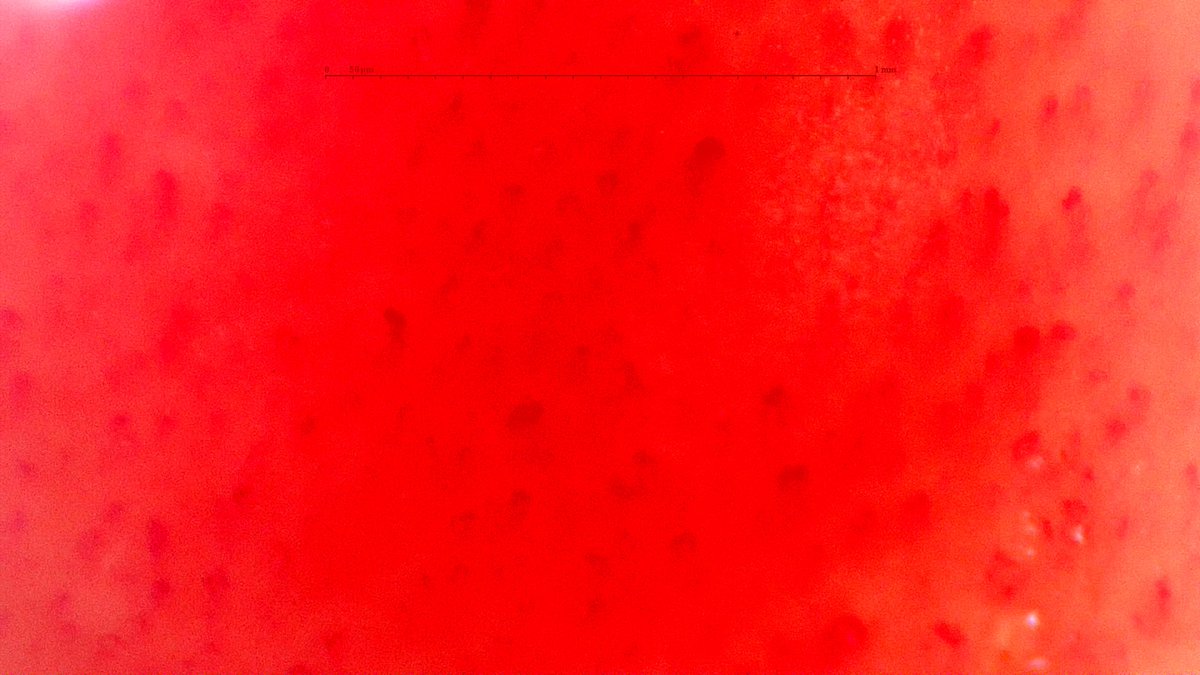 gmaldonadovelez's tweet photo. Capillaroscopy in a healthy subject/climber ๐ง๐ฝโโ๏ธ with history of blunt trauma to the 5th digit ๐ชข
๐ฅ Hemosiderin deposits
๐ฅ Considerable collection of blood
#MedTwitter #Rheumatology #RheumTwitter #Capillaroscopy #CapillaryIo https://t.co/eeqjJ6Bewo