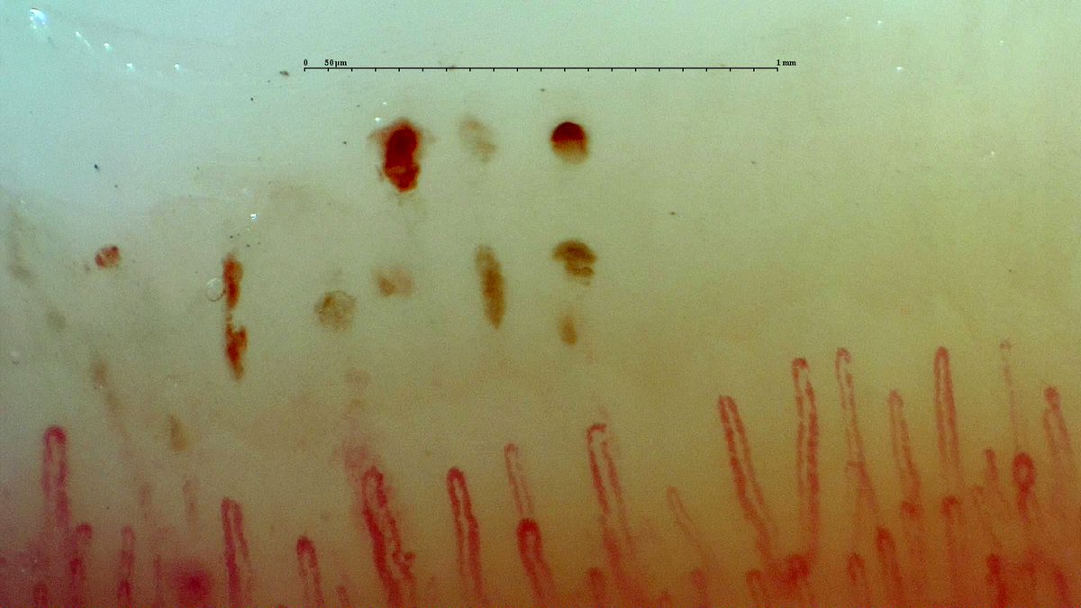 gmaldonadovelez's tweet photo. Capillaroscopy in a healthy subject/climber ๐ง๐ฝโโ๏ธ with history of blunt trauma to the 5th digit ๐ชข
๐ฅ Hemosiderin deposits
๐ฅ Considerable collection of blood
#MedTwitter #Rheumatology #RheumTwitter #Capillaroscopy #CapillaryIo https://t.co/eeqjJ6Bewo