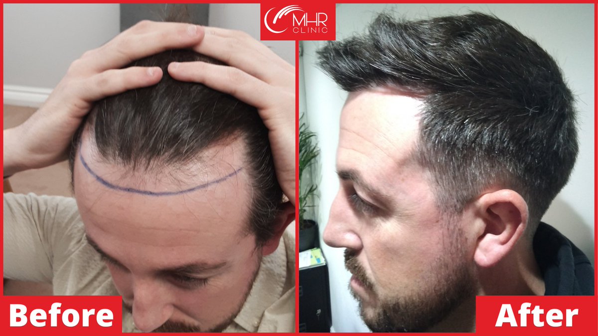 MHRClinicUK's tweet photo. Thomas underwent FUE implants to his hairline along with specialised prescription medication.

Thomas’s goal was to gain a full natural hairline, which he now has!

An incredible 10 month post operation picture to show the outstanding progress. https://t.co/J97L1Lre7e