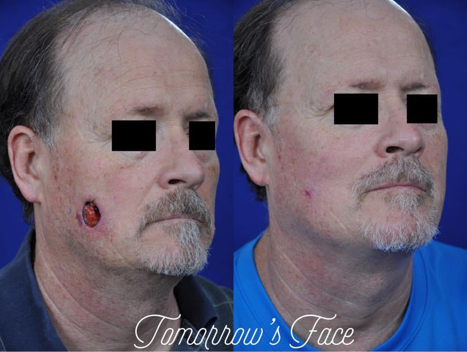 TomorrowsFace's tweet photo. Patients are often shocked at the size of the defect following #MOHS #FacialSurgery for removal of #SkinCancer. However, #FacialReconstruction performed by a #BoardCertified #FacialPlasticSurgeon like #DrMorrow can often achieve results where the #scar is barely noticeable! https://t.co/nx65qHyHvc