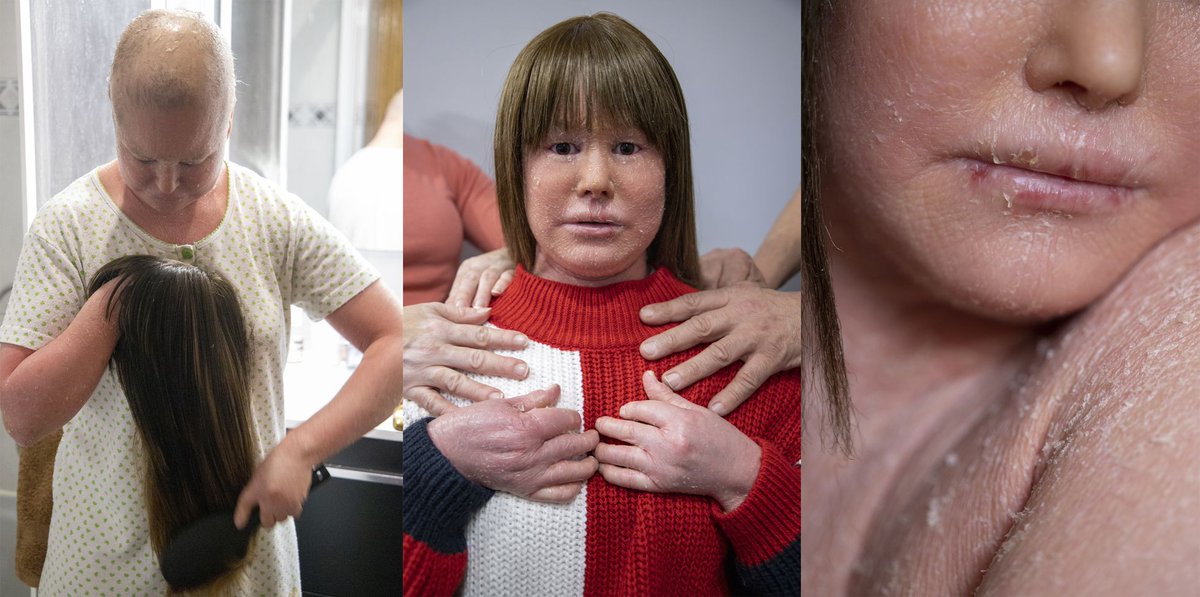 guerraypaz's tweet photo. Hoy publicamos en @el_pais este trabajo de @galaeaphoto , una fotógrafa novel que ha documentado el día a día de Ariadna, una joven que sufre de ictiosis arlequín. Como editor gráfico, es una suerte contar con trabajos tan bien elaborados como este  https://t.co/SkSoYIRCFZ https://t.co/4DXro9L6TH