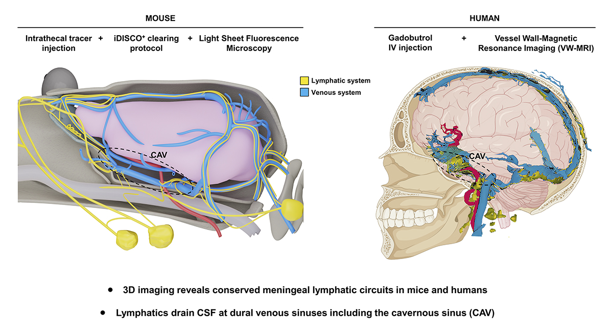JExpMed's tweet photo. Jacob, Eichmann, Thomas and colleagues @InstitutCerveau suggest that vessel-wall (VW) magnetic resonance imaging (VW-MRI) may provide a diagnostic tool for patients with CSF drainage defects and neurological diseases. https://t.co/OLyyjv0jrC https://t.co/Gw3IGK0DjJ