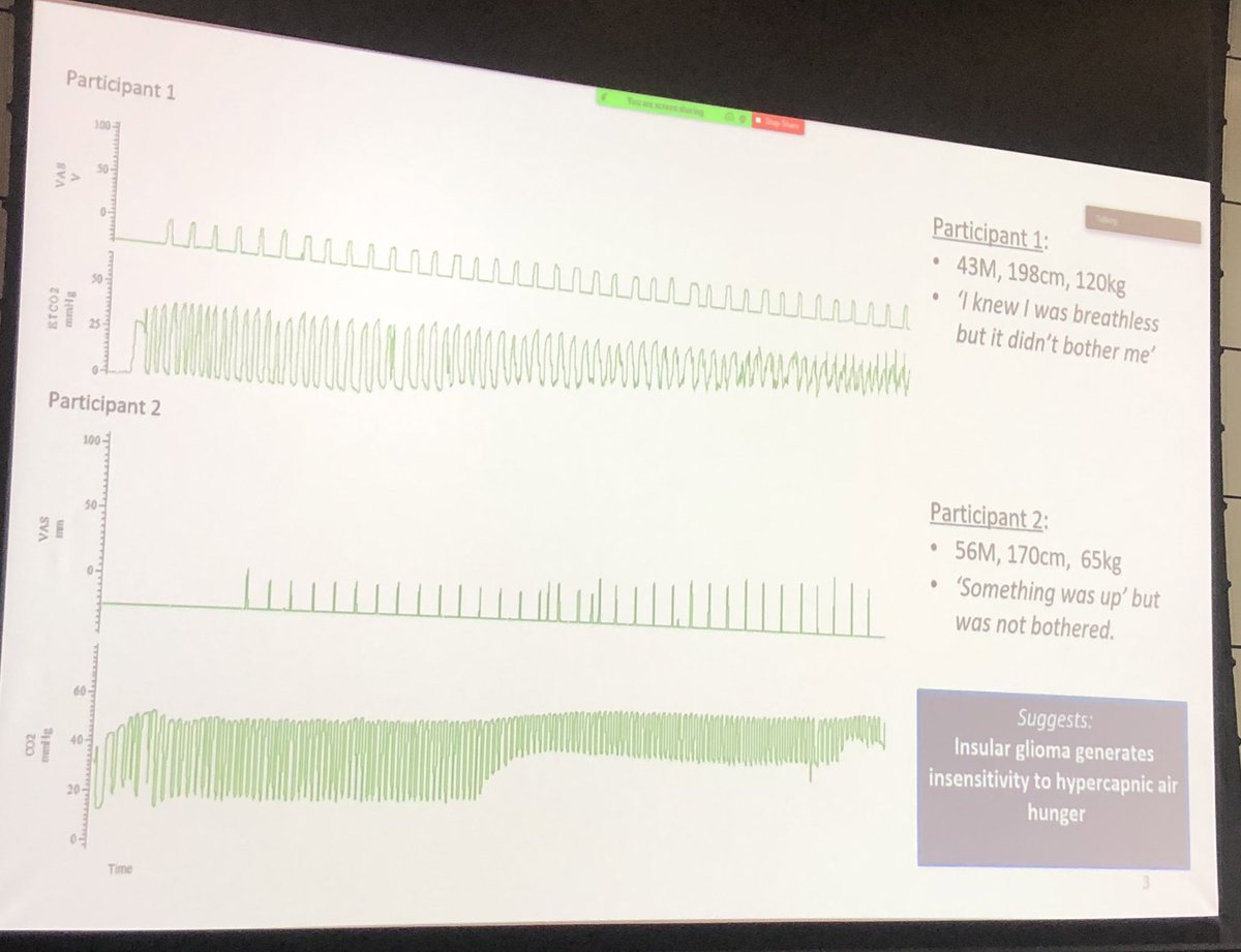 DrLJ π (@drlaurajane) on Twitter photo Striking case studies of patients with low-grade insular glioma with insensitivity to experimentally induced air hunger! Fascinating insight into the brain & #breathlessness #dyspnea2022 <a href="/Dyspnea2022/">Dyspnea 2022</a> Sarah Farrell presenting Striking case studies of patients with low-grade insular glioma with insensitivity to experimentally induced air hunger! Fascinating insight into the brain & #breathlessness #dyspnea2022 <a href="/Dyspnea2022/">Dyspnea 2022</a> Sarah Farrell presenting