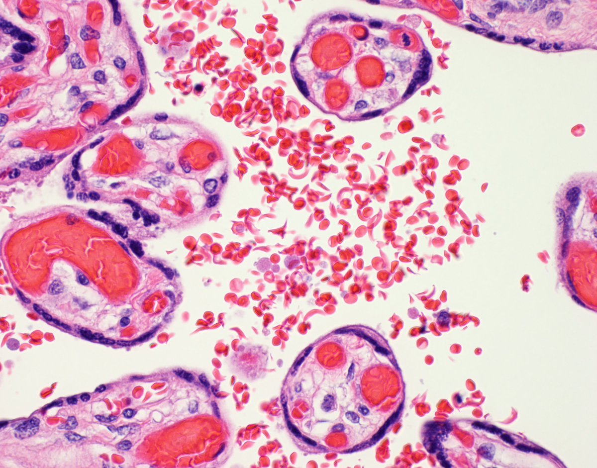 What does the appearance of the intervillous red blood cells here tell you about mom's medical history? #placenta #GYNpath #MedEd <a href="/NYUGSOMpathres/">NYUGSOM Pathology Residency</a> <a href="/nyugrossman/">NYU Grossman School of Medicine</a>