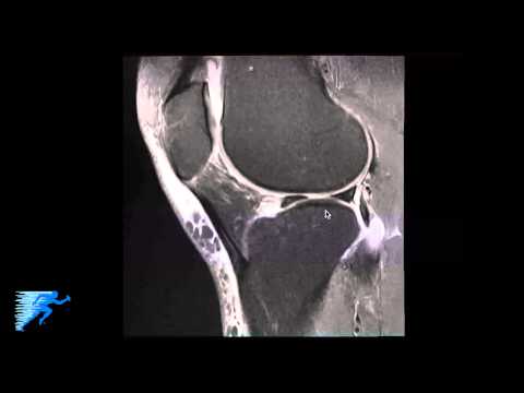 thekneedoc's tweet photo. In this video, Dr. LaPrade discusses how to read a #kneeMRI of a meniscal root tear. https://t.co/3u3eOHVes8 #orthotwitter #meniscus #mensicustear #meniscusroottear https://t.co/GQ0zX8ktSG