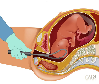 awkashi's tweet photo. Epidural anesthesia is a type of epidural commonly given for pain relief in childbirth and in some types of surgery. Some illustrations are below.
#epiduralbirth #medicalillustration #illustration #wksolutions #SUNGHOON https://t.co/vwXypWhW44